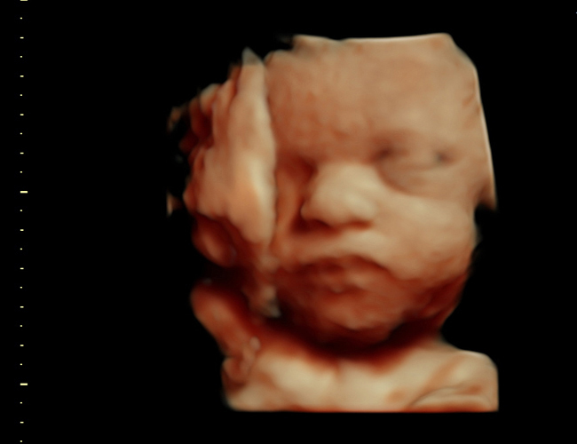 3D ultrasound image at 31 weeks